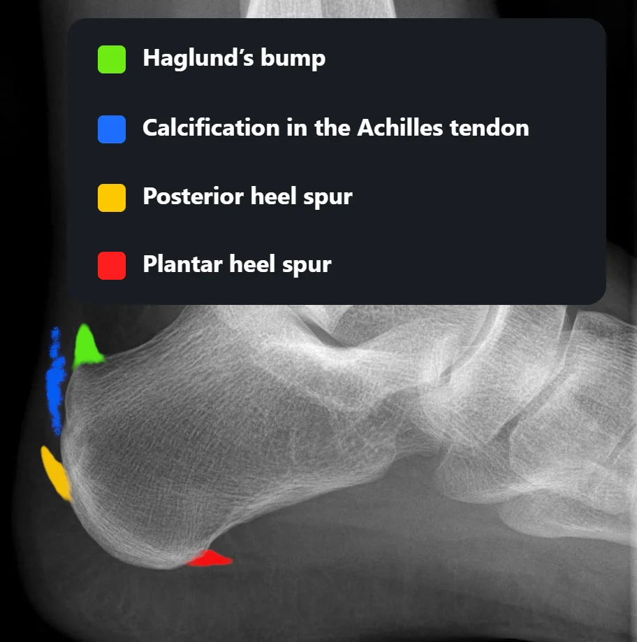 Side-view X-ray of the heel with the four places spurs and calcium form marked: a plantar heel spur under the heel, a posterior heel spur where the Achilles tendon attaches, calcification in the Achilles tendon, and a Haglund’s bump at the upper back of the heel bone.