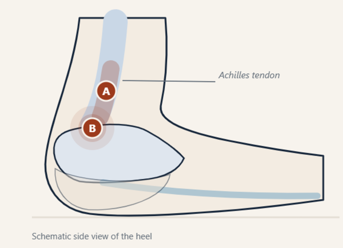 Schematic side view of the heel showing the Achilles tendon with two marked zones: A in the mid-portion of the cord above the bone, and B at the insertion onto the back of the heel bone.