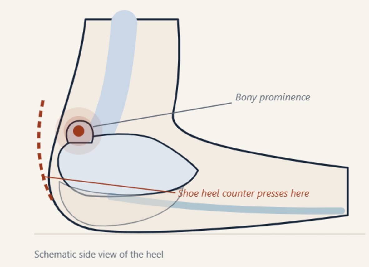 Schematic side view of the back of the heel showing a bony prominence at the upper back corner of the heel bone and the line where a shoe heel counter presses against it.