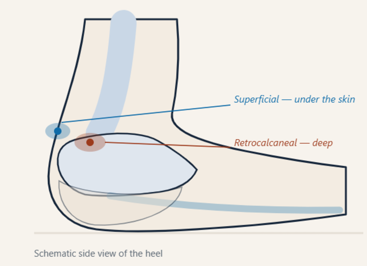 Schematic side view of the back of the heel showing the superficial bursa between the Achilles tendon and the skin, and the retrocalcaneal bursa deep to the tendon against the heel bone.