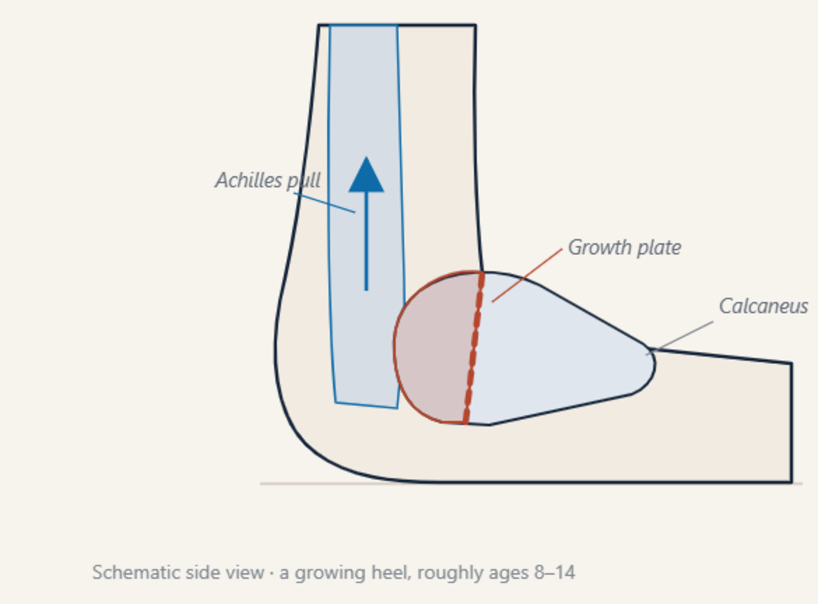 Schematic side view of a growing heel showing the calcaneal apophysis separated from the heel bone by a cartilage growth plate, with the Achilles tendon pulling upward on it.
