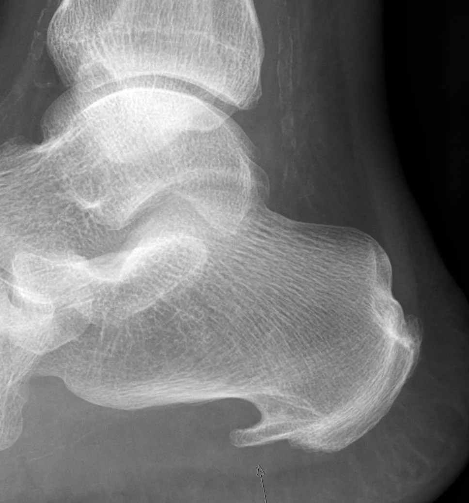 Side-view X-ray of the heel showing a large plantar calcaneal spur: a bony point on the underside of the heel bone, pointing towards the toes.