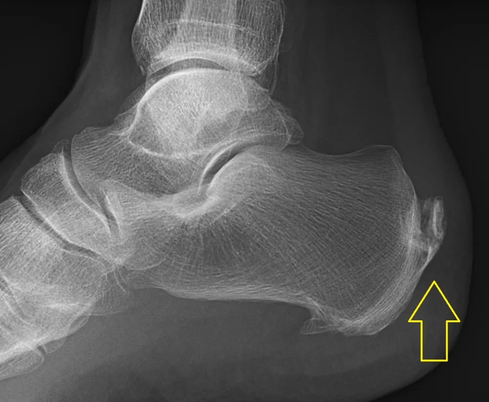 Side-view X-ray of the heel with an arrow pointing to a posterior heel spur: calcium formed where the Achilles tendon attaches to the back of the heel bone.