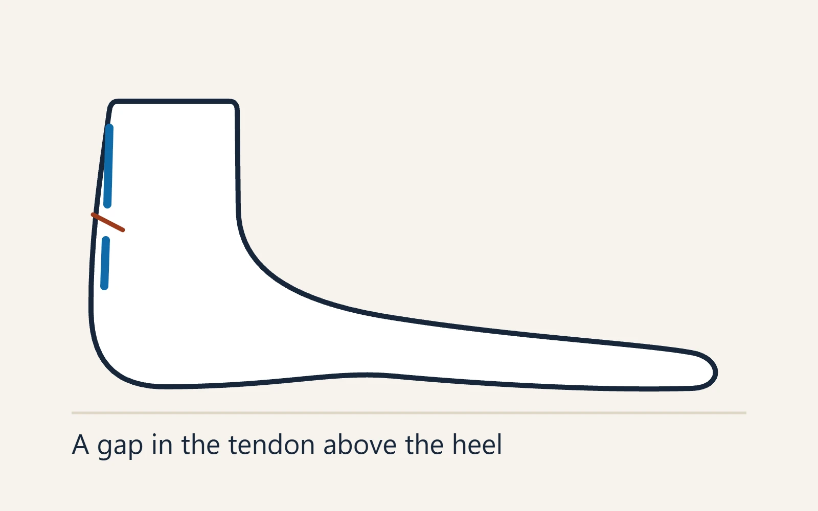 Schematic side view of the foot: A gap in the tendon above the heel
