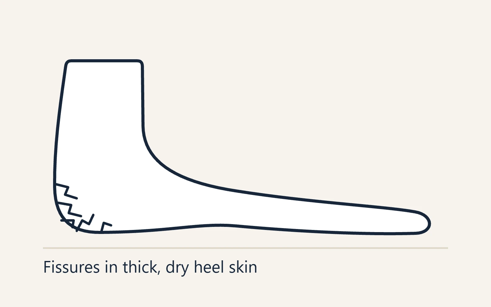 Schematic side view of the foot: Fissures in thick, dry heel skin