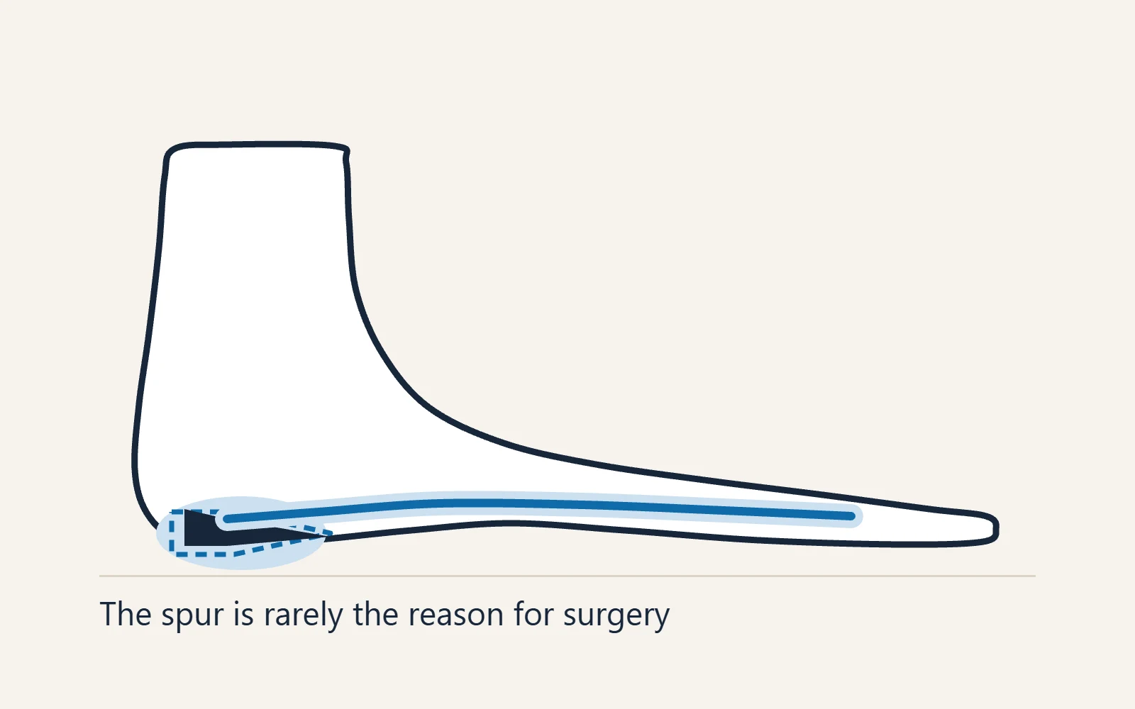 Side view of the foot with a heel spur outlined by a dashed line on the underside of the heel bone