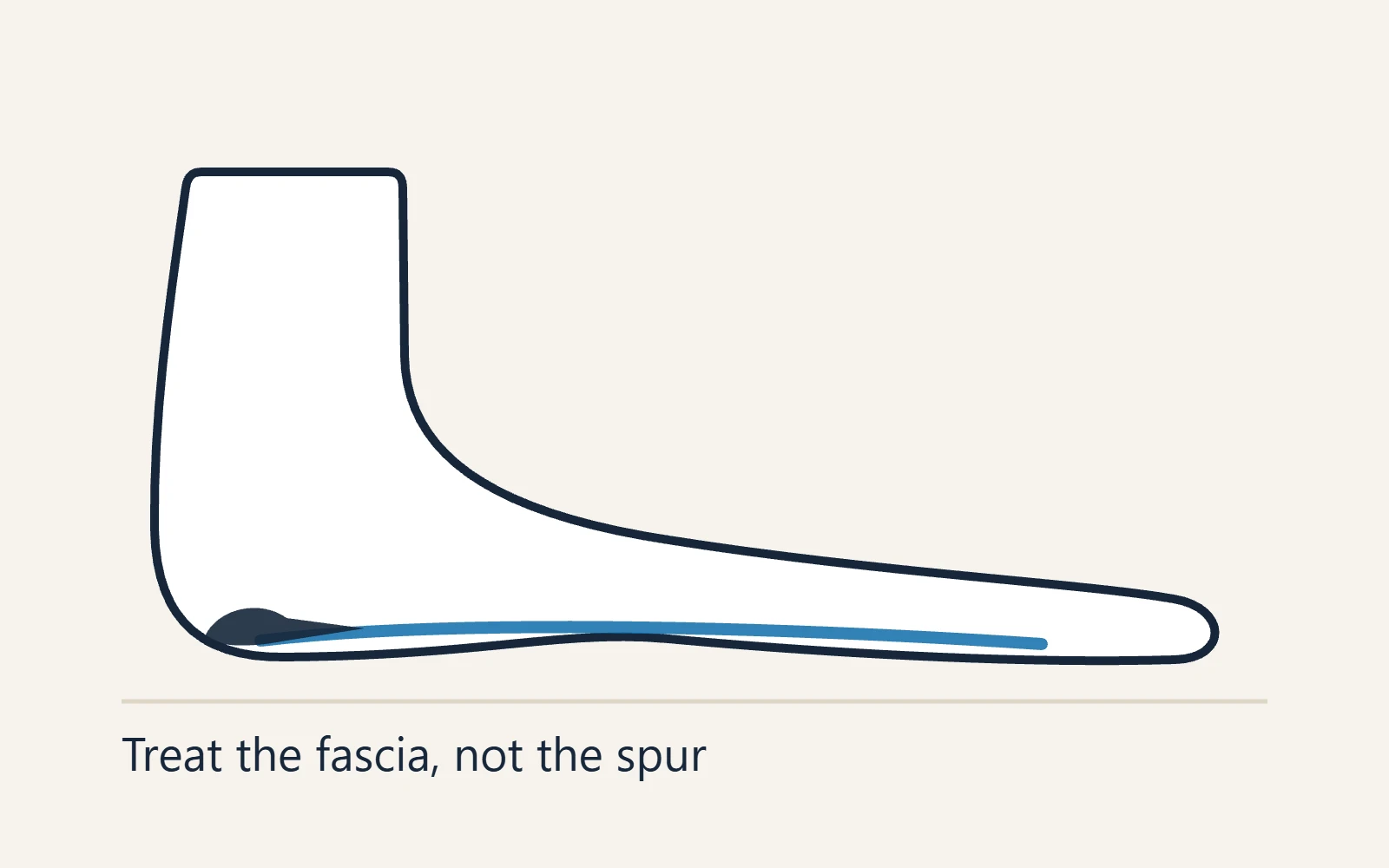 Schematic side view of the foot: Treat the fascia, not the spur