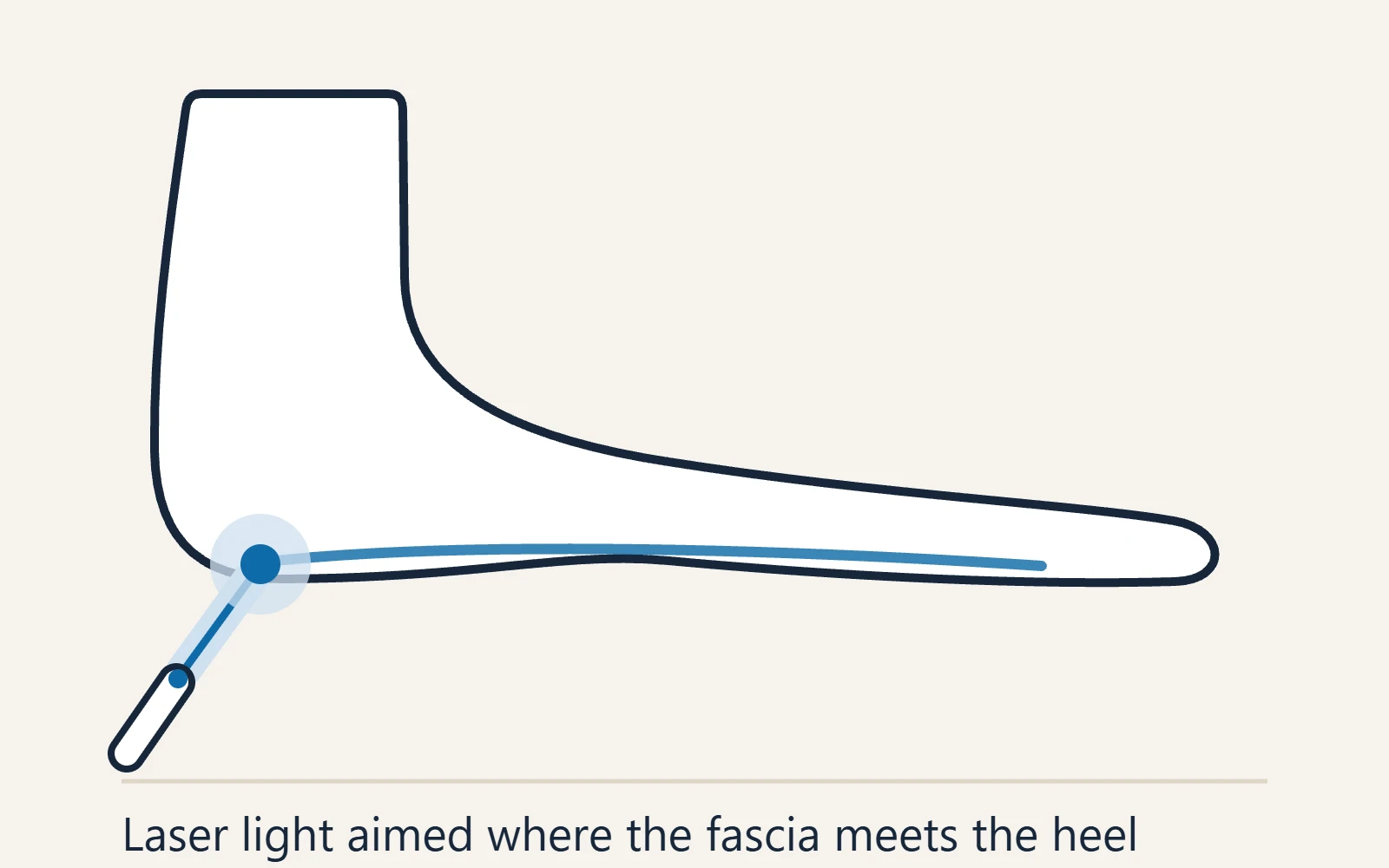 Schematic side view of the foot: laser light aimed at the sore attachment under the heel