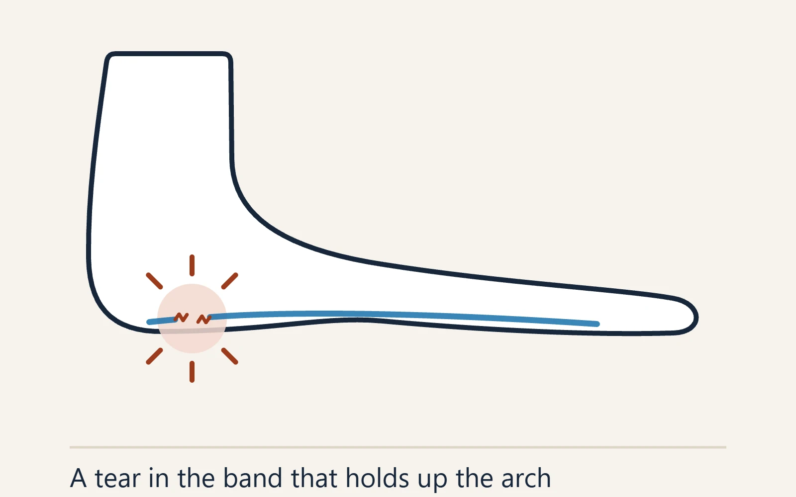 Schematic side view of the foot: the plantar fascia band under the arch with a tear near the heel