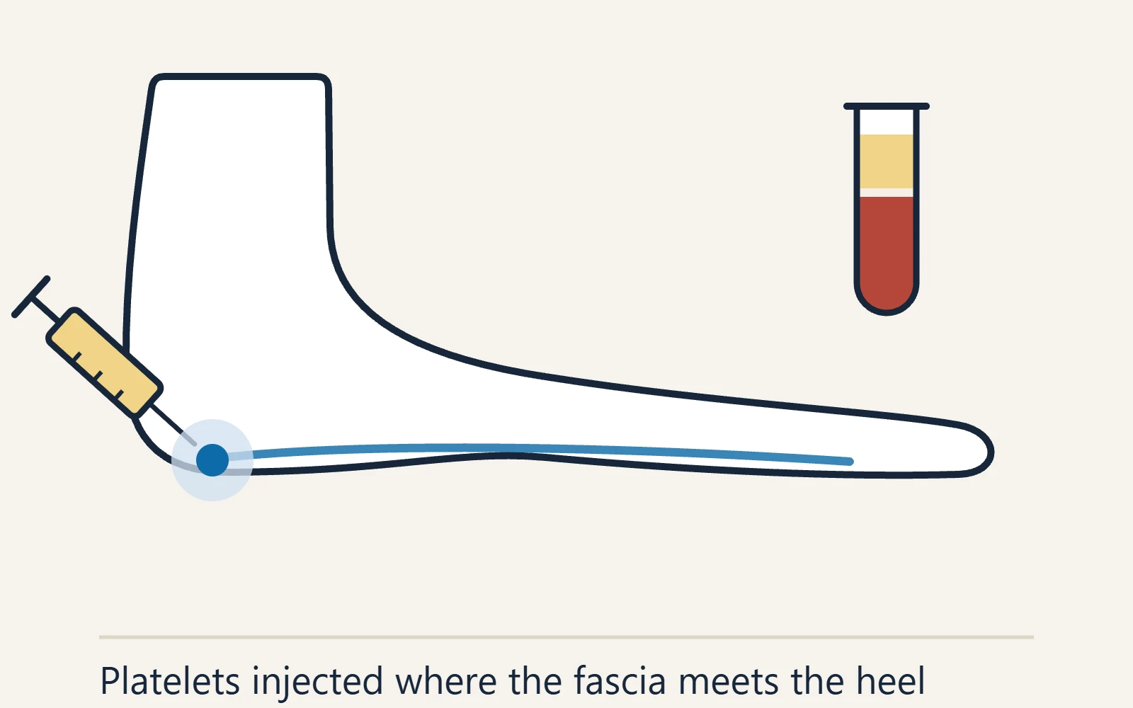 Schematic side view of the foot: a platelet-rich plasma injection aimed where the fascia meets the heel, beside a tube of separated blood