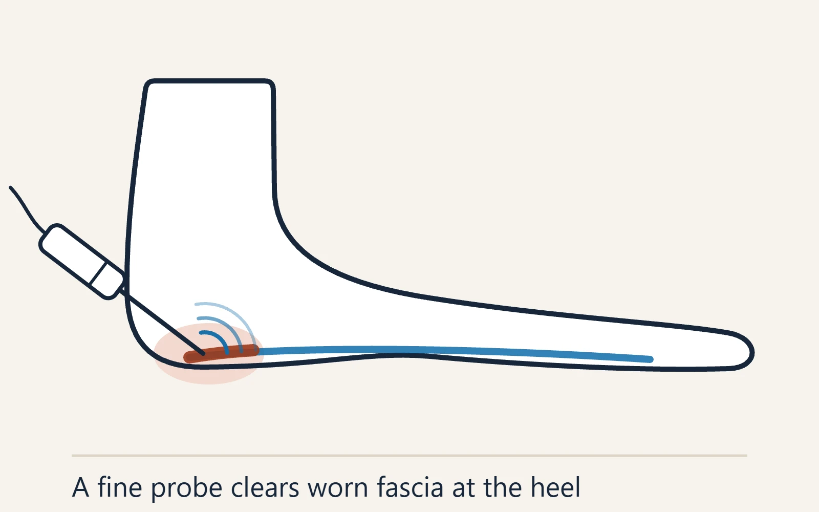 Schematic side view of the foot: a fine ultrasonic probe entering the heel where the worn plantar fascia attaches